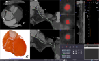 CT冠動脈解析2のキャプチャー画像