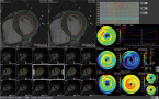 MR心機能解析2のキャプチャー画像