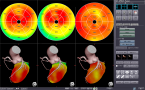 CT/SPECT心臓フュージョンのキャプチャー画像