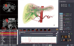 CT肝臓体積測定のキャプチャー画像